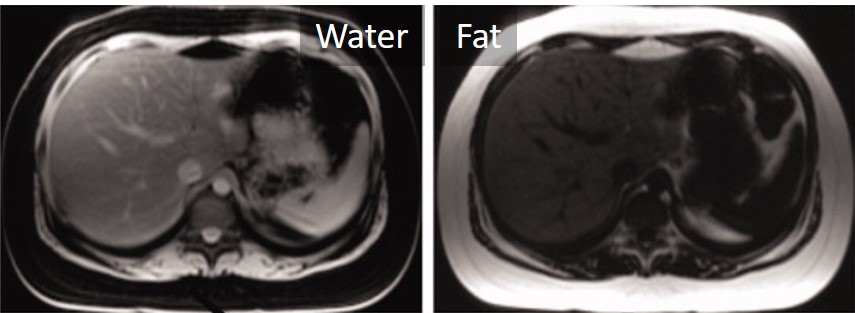 Example water and fat MR images of the liver