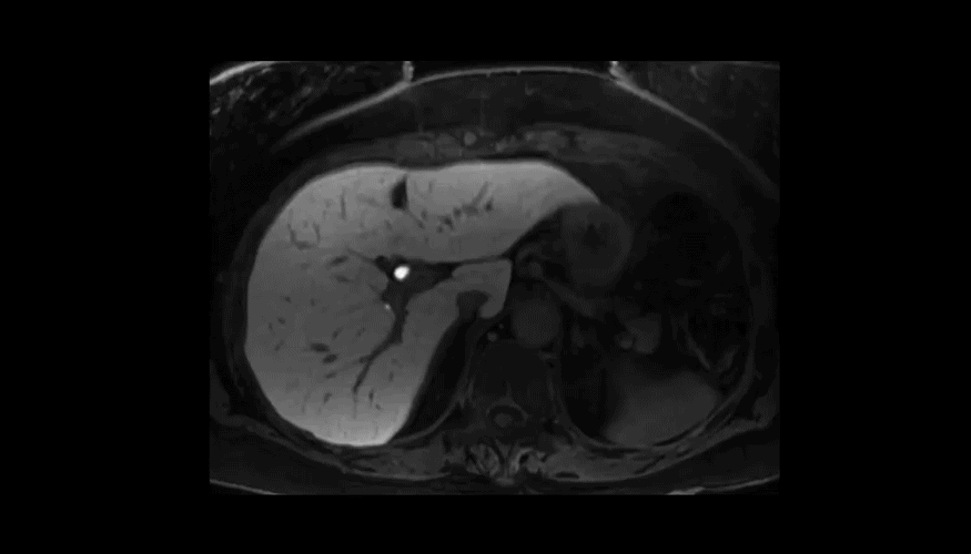Animated MR image showing the liver before and after contrast, with arrows to indicate lesions