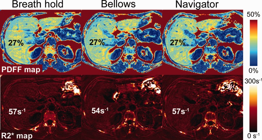 Example PDFF and R2* maps of the liver with different motion mitigation strategies.